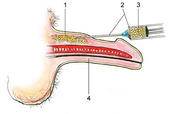 Lipofilling - l'inserimento di tessuto adiposo nell'asta del pene