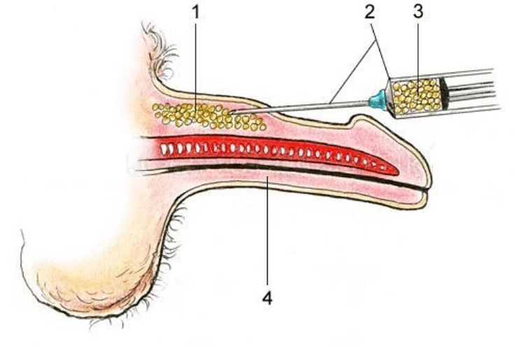 Lipofile per aumentare un membro