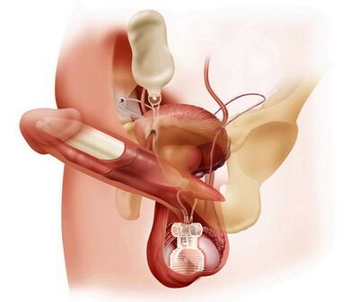 ingrandimento chirurgico del pene